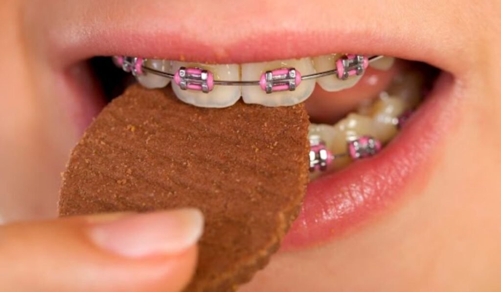 Types of Chocolate Safe for Braces